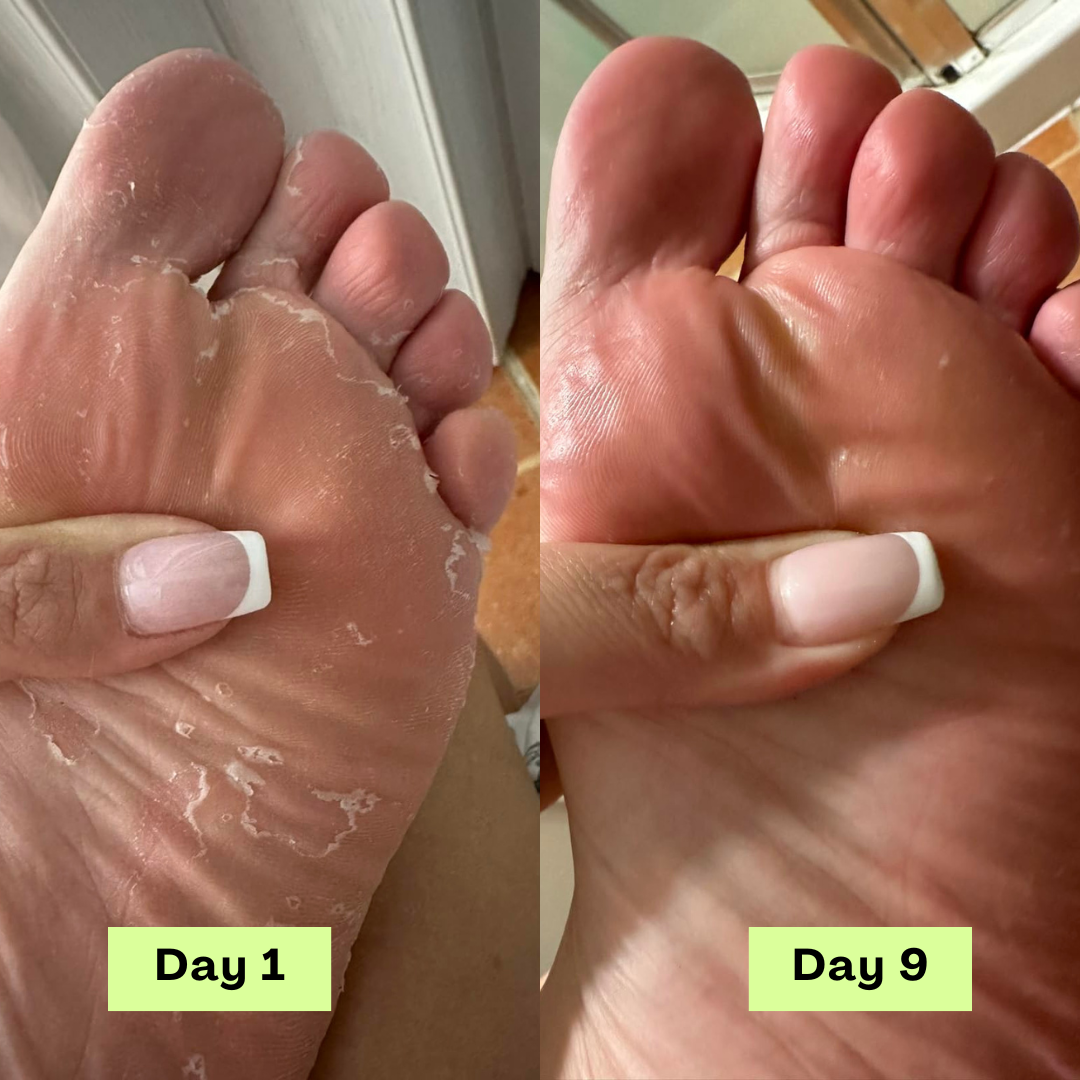 Kelorah® AntiFungal Relief Soap Bar