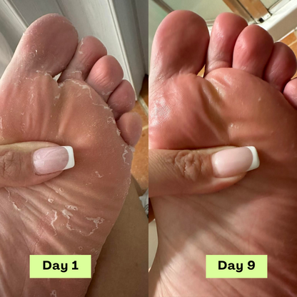 Kelorah® AntiFungal Relief Soap Bar