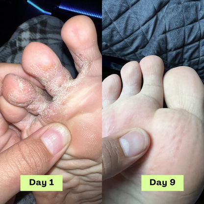 Kelorah® AntiFungal Relief Soap Bar